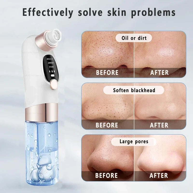Electric Pore Vacuum Blackhead Remover